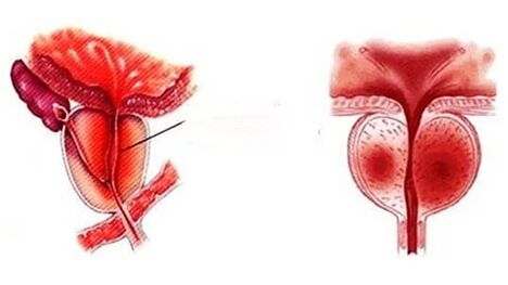 كيف ترى التهاب البروستاتا المزمن